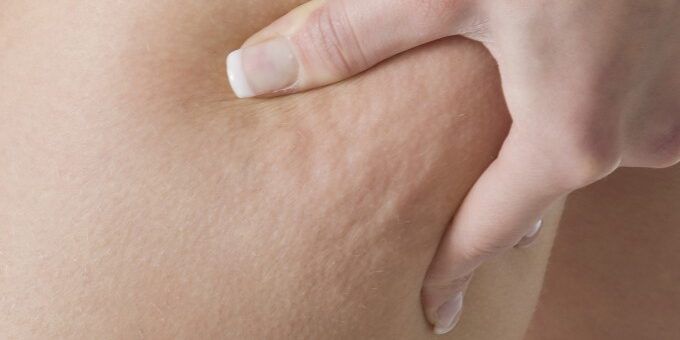 celulitis-quantum-technology1-680×1024