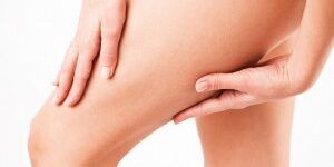 CELLULITIS-300×200