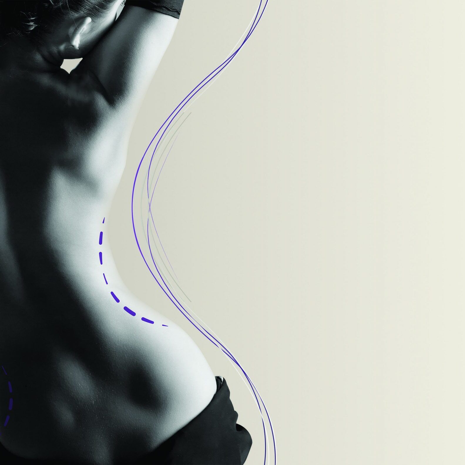 remodelacion corporal con ultrasonidos y radiofrecuencia