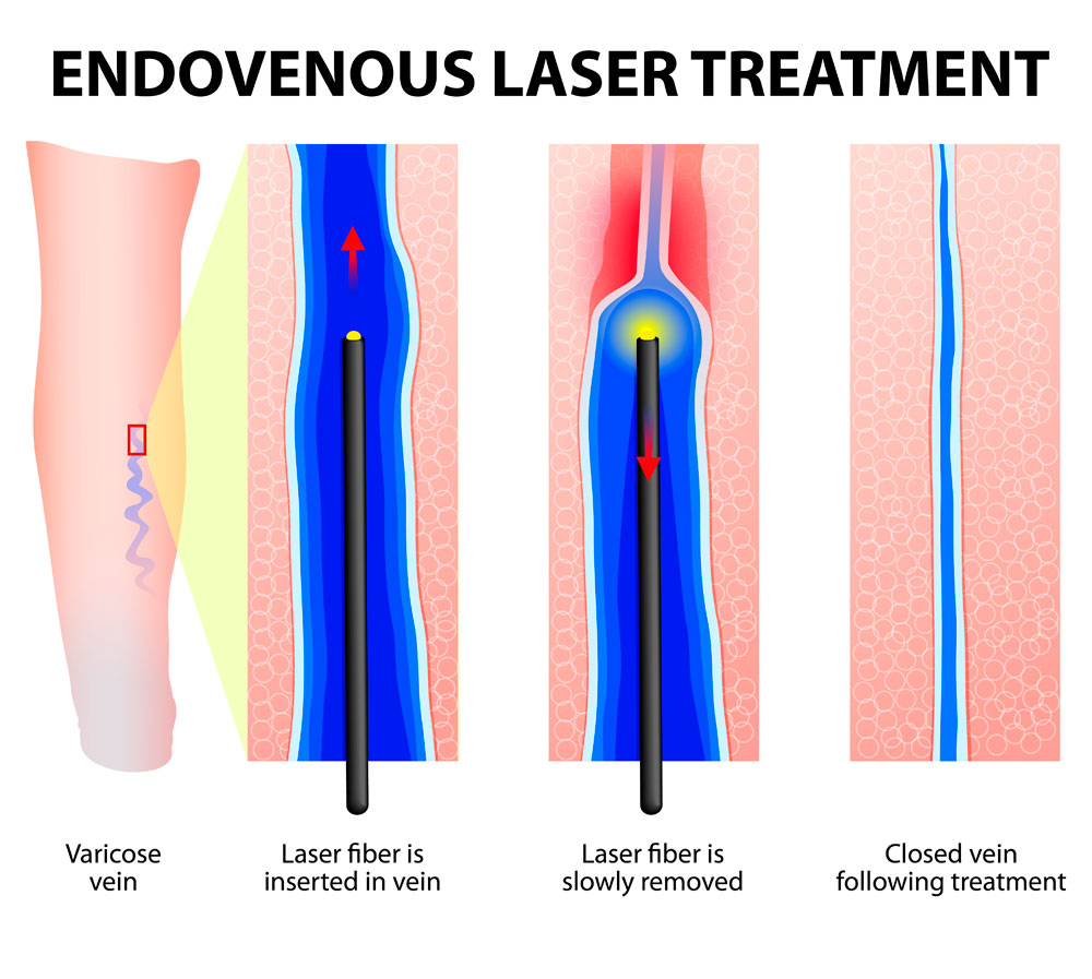 Láser endovascular