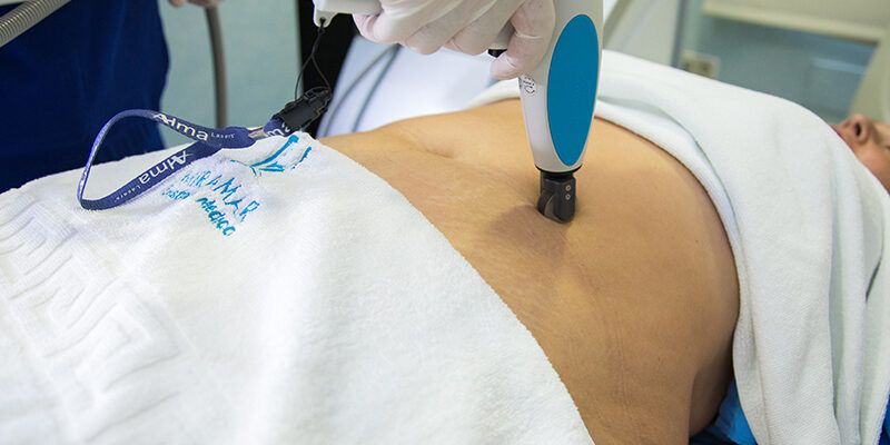 Tratamiento Estrías Blancas Cómo eliminar las estrías