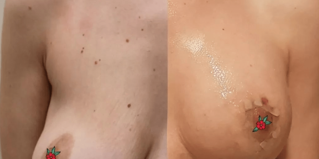 Comparativa antes y después de un aumento de pecho, vista de espalda y hombros de la paciente