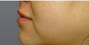 ANTES-Y-DESPUES-29-300×300-DESPUES