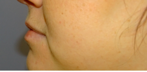 ANTES-Y-DESPUES-29-300×300-antes