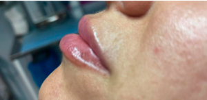 ANTES-Y-DESPUES-30-300×300-DESPUES